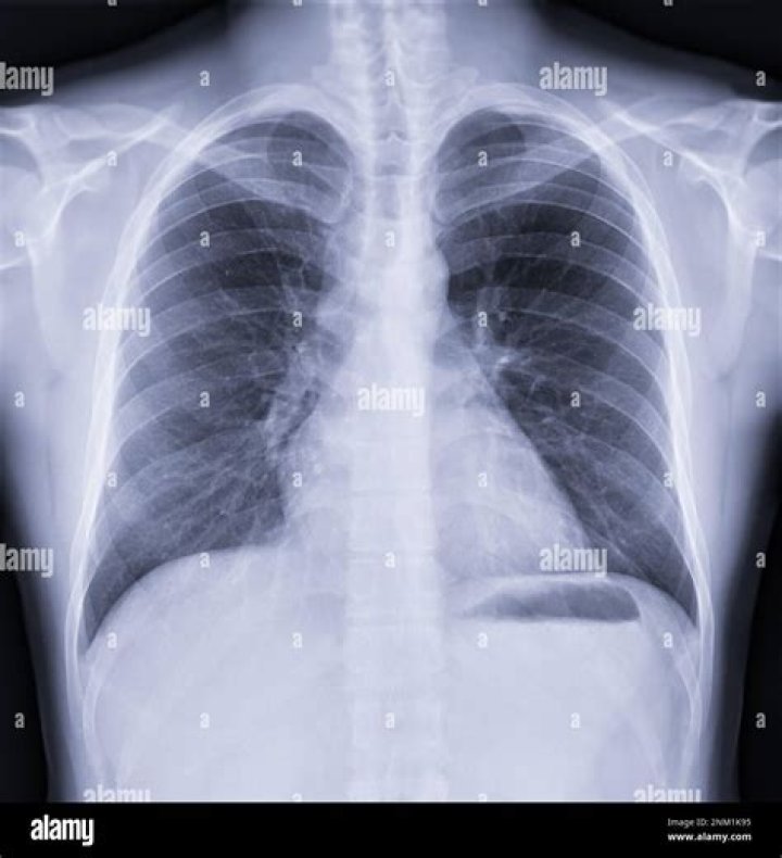 normal chest